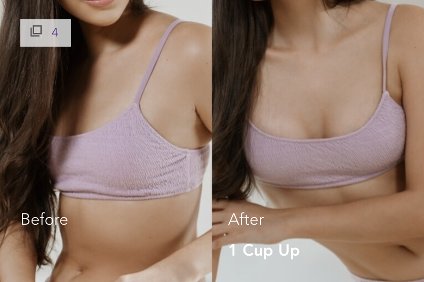 mia-femtech-breast-implant-harmonization-istanbul-1 Mia Femtech Breast Implant Harmonization Before After